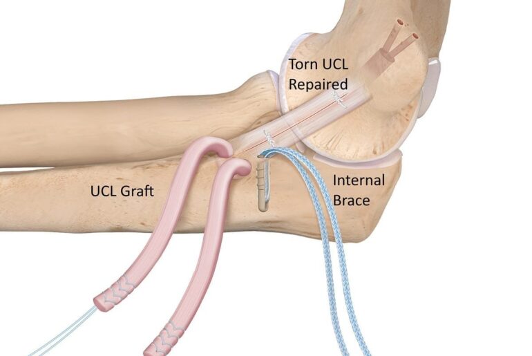 Présentation d'un produit qui change la donne : la chirurgie triple Tommy John – TJ3